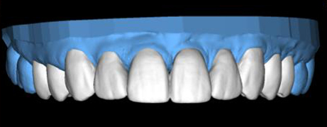 Digital model of upper row of teeth