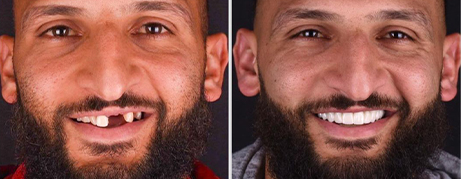 Man smiling before and after replacing missing teeth