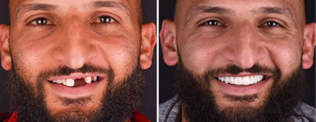 Man smiling before and after replacing missing teeth