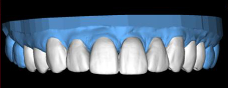 Digital model of an upper row of teeth