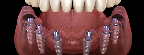 Illustration of implant dentures
