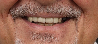 Greggory&rsquo;s smile before treatment