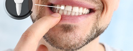 A man showing his implanted tooth against a light background