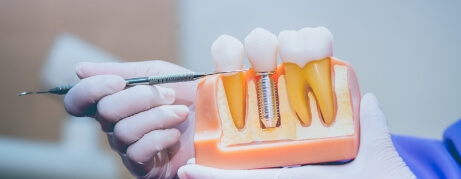 Dentist holding a model of a dental implant in the jaw