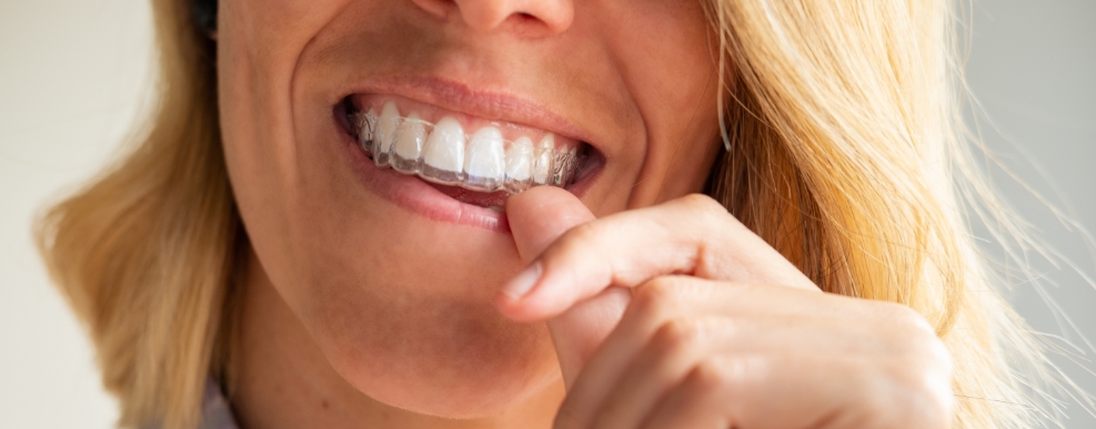 Woman placing clear aligner over her upper teeth