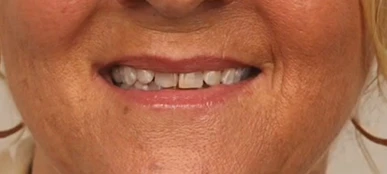 Donna&rsquo;s smile before treatment