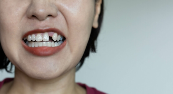 Close up of woman missing an upper tooth