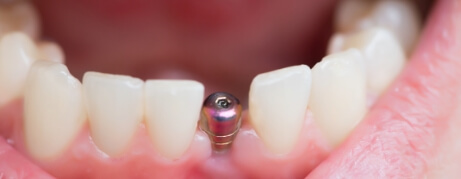 Close up of mouth with a dental implant replacing a missing tooth