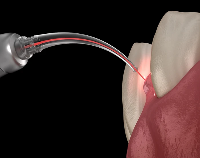Illustration of a soft tissue laser treating the gums
