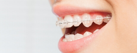 Close up of person smiling with traditional braces