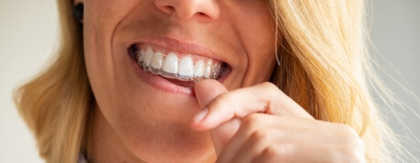 woman placing a clear aligner over her upper teeth