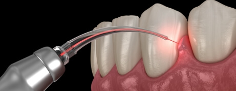 Illustrated dental laser treating gum disease