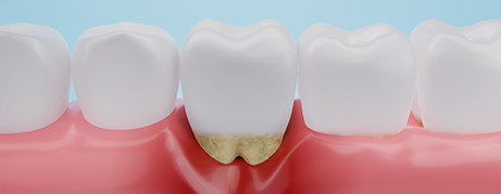 Illustrated tooth with receding gums