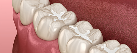 Illustrated row of teeth with dental sealants