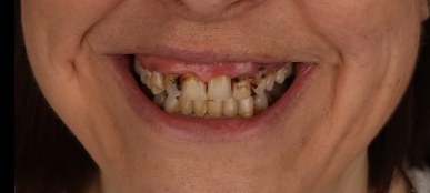Salina&rsquo;s smile before treatment