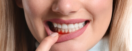Woman pointing to red spot in her gums