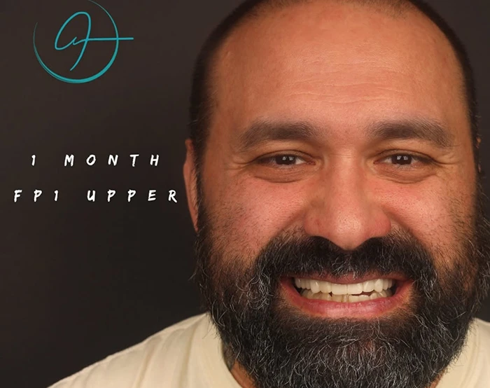 Silfa Dental patient smiling one month into treatment