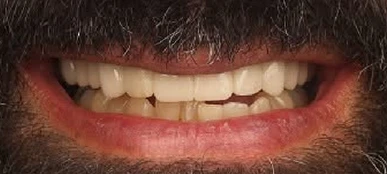 Our patient&rsquo;s smile before treatment