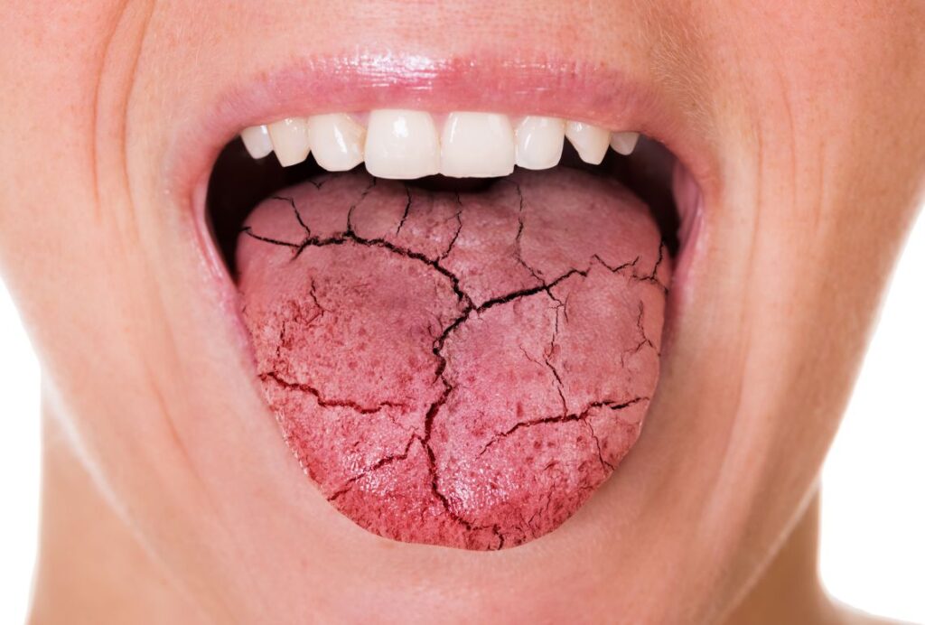 A CGI of a cracked tongue